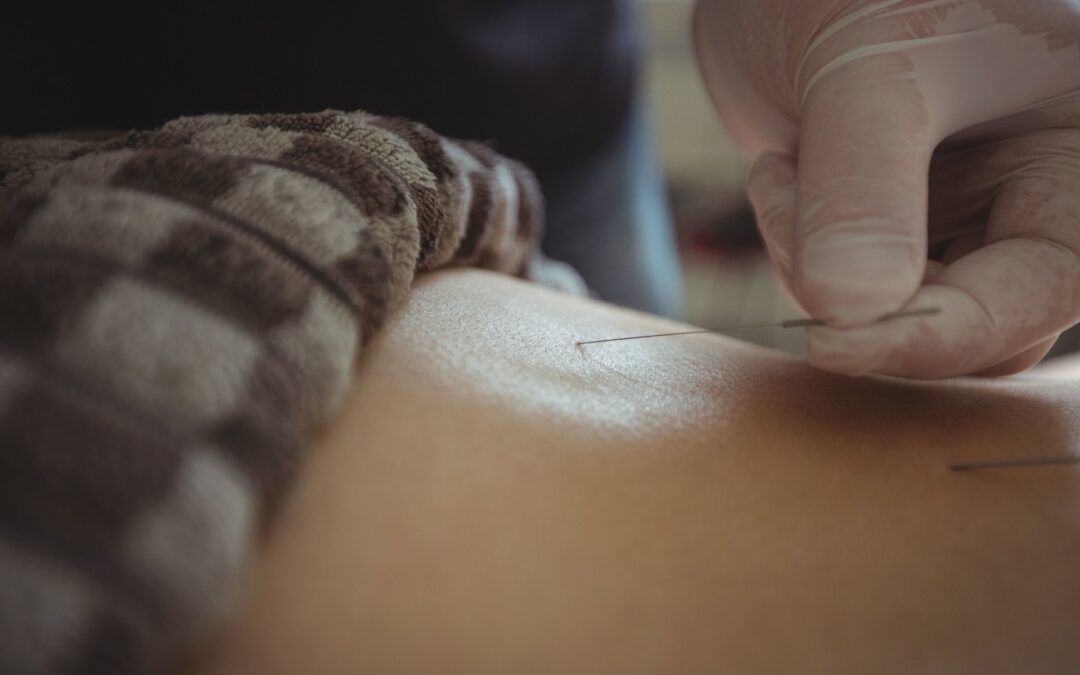 Acupuncture